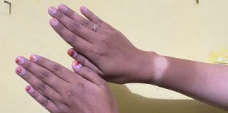 Kok Bisa Kulit Belang Walau Musim Hujan? Ini Jawabannya