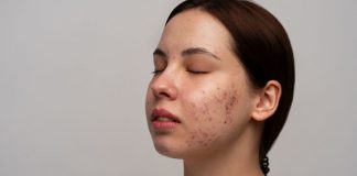 Kenapa Kurang Tidur Bisa Picu Jerawat? Ini Penjelasannya!