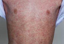 Kasus Campak Meningkat di Probolinggo, 17 Suspek Ditemukan Awal 2026