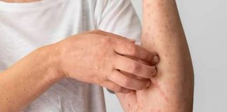 Terkena Air Banjir Bikin Gatal, Lakukan 6 Cara Ini Agar Cepat Sembuh!