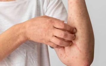 Terkena Air Banjir Bikin Gatal, Lakukan 6 Cara Ini Agar Cepat Sembuh!