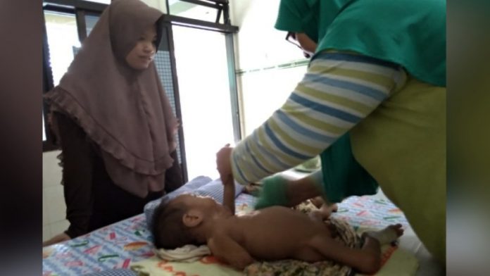 Rasya, Balita Penderita Gizi Buruk di Kota Pasuruan